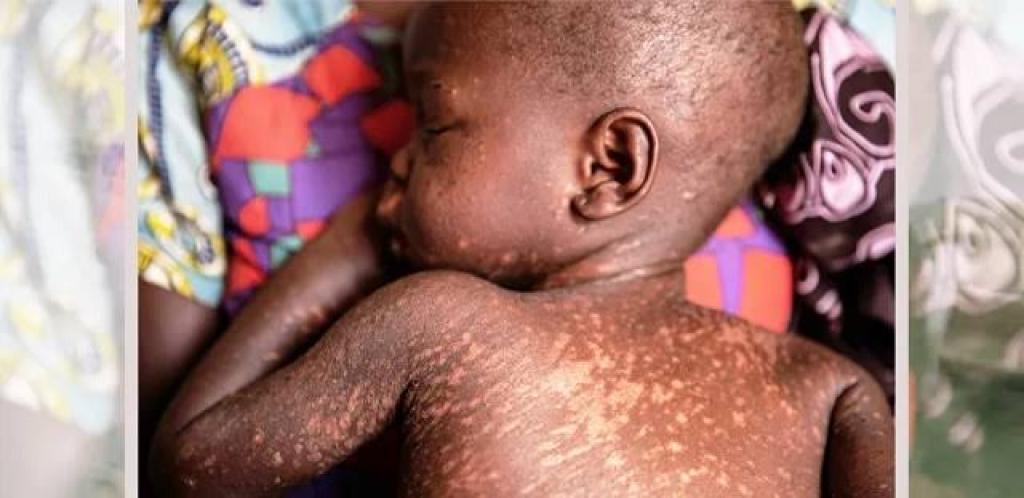 Measles outbreak claims 32 lives in Ugandan districts